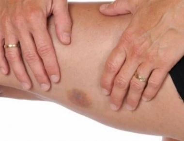 Κάνετε μελανιές «χωρίς λόγο»;- Δείτε τι μπορεί να σας συμβαίνει